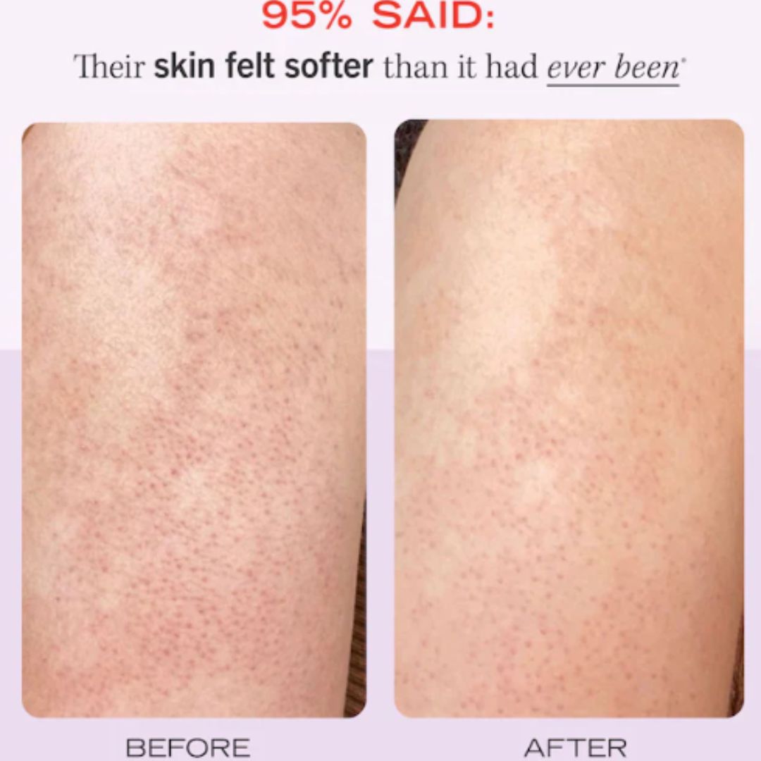 First Aid Beauty KP Bump Eraser Body Scrub with 10% AHA